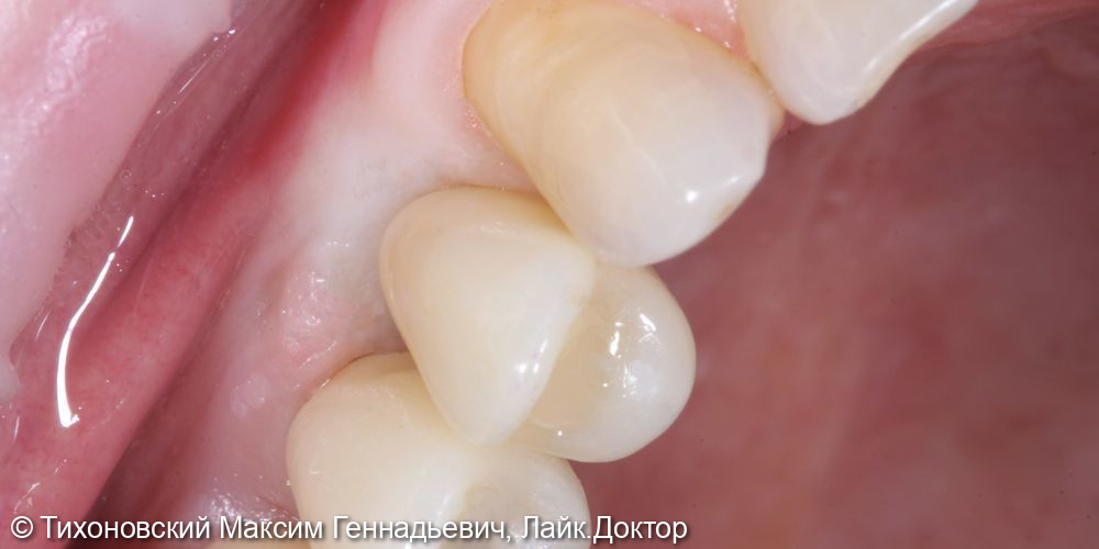 Восстановление утраченного зуба имплантатом и коронкой из ZrO2 - фото №2