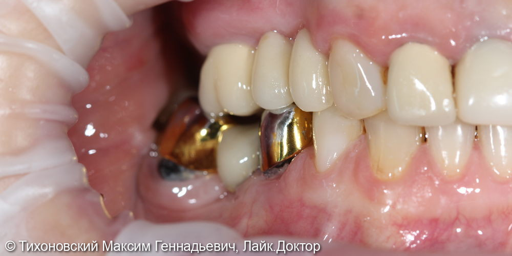 Восстановление боковой группы зубов с помощью имплантатов - фото №1
