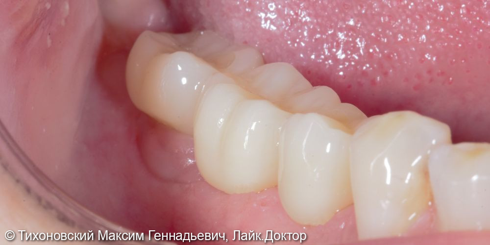 Восстановление боковой группы зубов с помощью имплантатов - фото №2