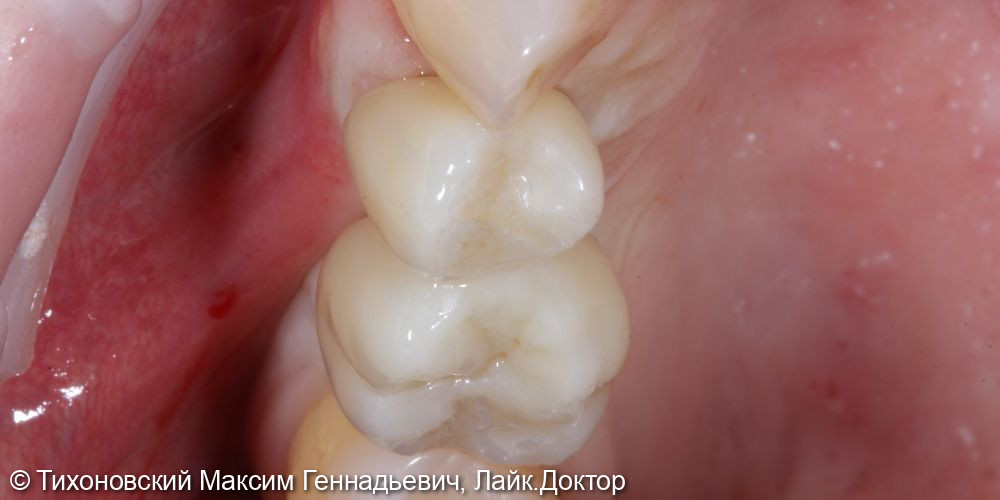 Восстановление утраченных зубов с помощью имплантов - фото №2