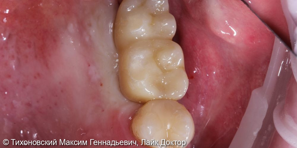 Замещение утраченных зубов в области верхней челюсти слева - фото №2