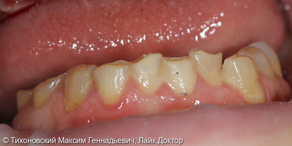 Тотальная реабилитация пациента с частичной адентией зубов на нижней челюсти и повышенной стираемости - фото №1