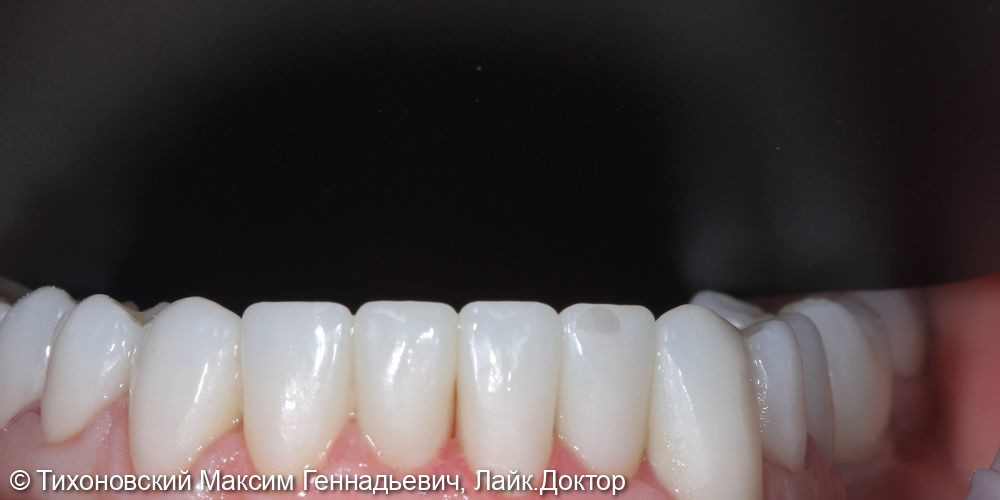 Тотальная реабилитация пациента с частичной адентией зубов на нижней челюсти и повышенной стираемости - фото №2