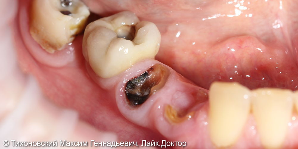 Восстановление жевательной функции зубов в боковом отделе на нижней челюсти справа - фото №1