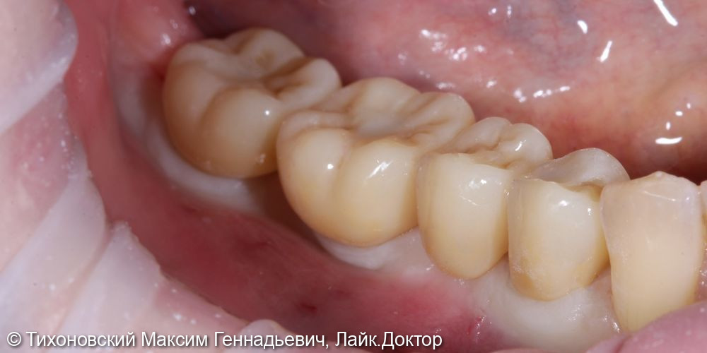 Восстановление жевательной функции зубов в боковом отделе на нижней челюсти справа - фото №2