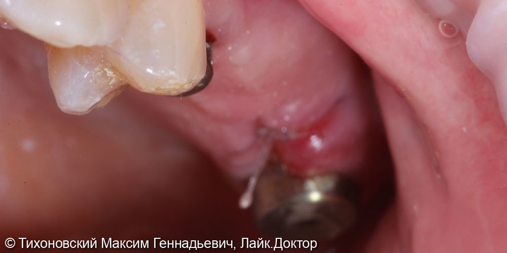 Замещение утраченных зубов имплантами Nobel и коронками из ZrO2 - фото №1