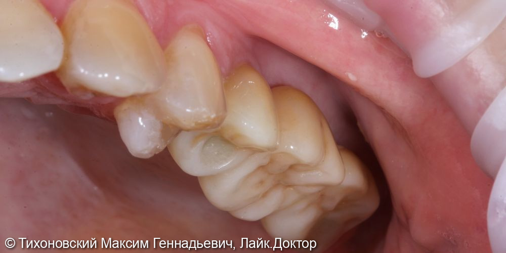 Замещение утраченных зубов имплантами Nobel и коронками из ZrO2 - фото №2