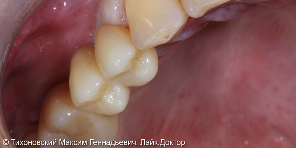 Наращивание костной ткани в области давно удаленных зубов и замещение утраченных зубов имплантами - фото №2