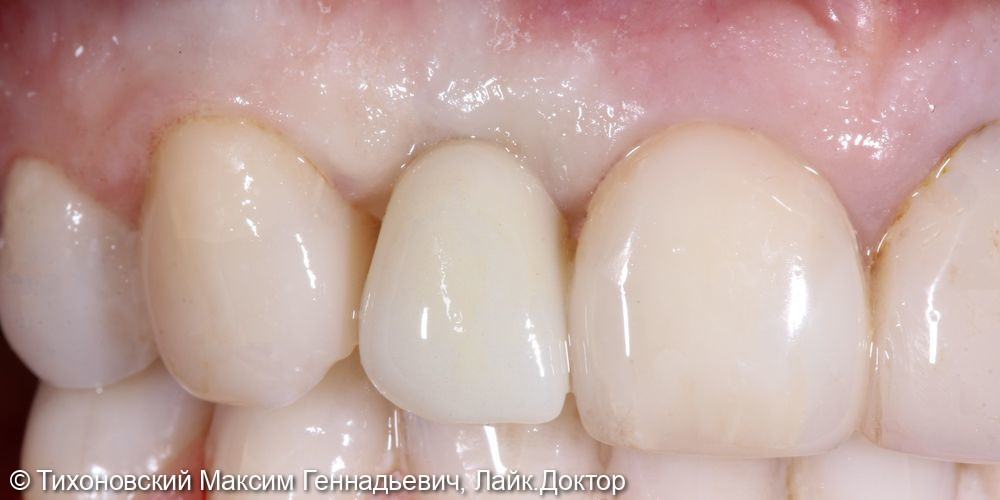 Удаление и одномоментная имплантация в области 12 зуба - фото №2