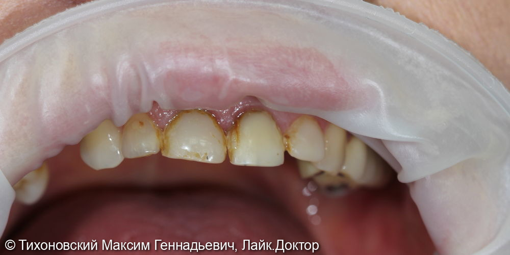 Установка коронок из ZrO2 на восстановленные зубы и замещение утраченных зубов имплантами - фото №1