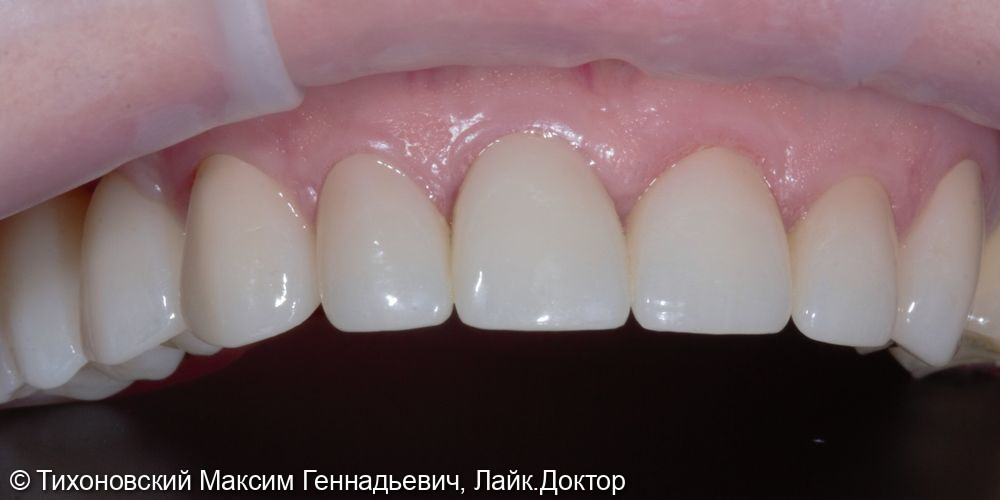 Установка коронок из ZrO2 на восстановленные зубы и замещение утраченных зубов имплантами - фото №2