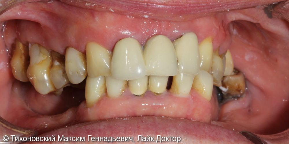 Тотальная работа на имплантах и своих зубах - фото №1