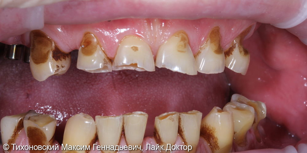 Тотальная работа с сохранением своих зубов и реабилитацией на имплантатах - фото №1