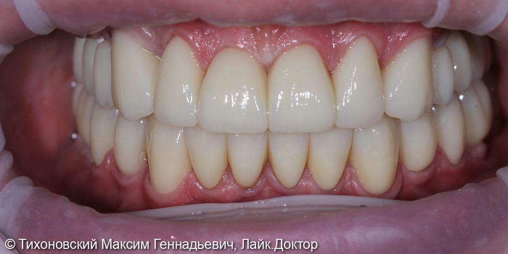 Тотальная работа с сохранением своих зубов и реабилитацией на имплантатах - фото №2