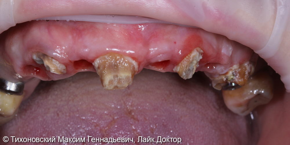 Тотальная реабилитация пациента с дефектами на верхней челюсти - фото №1