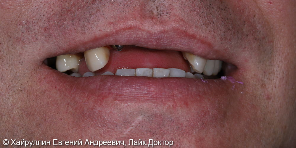 Протезирование на фронтальной части зубов - фото №1