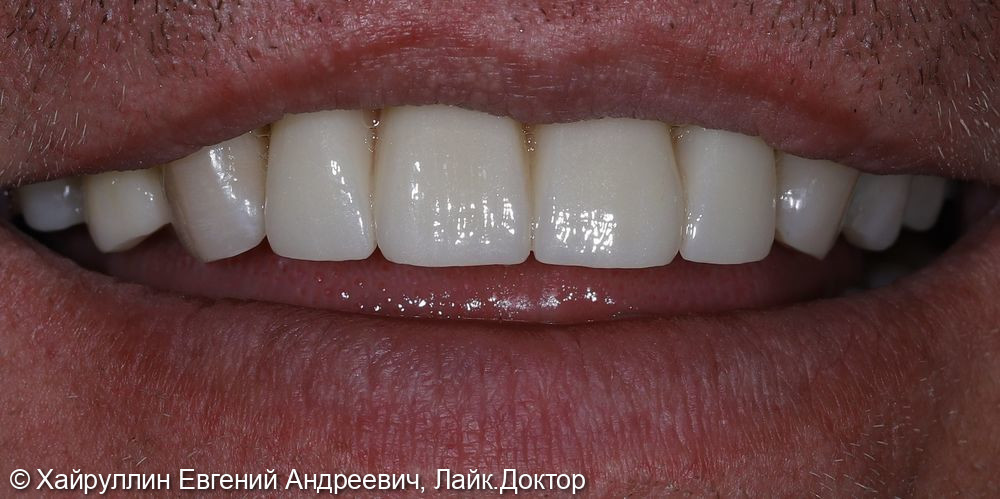 Протезирование на фронтальной части зубов - фото №2