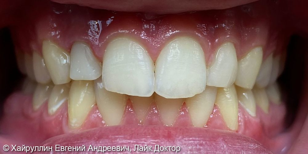 Протезирование зуба 1.2 коронкой из диоксида циркона - фото №1