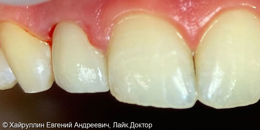 Протезирование зуба 1.2 коронкой из диоксида циркона - фото №2