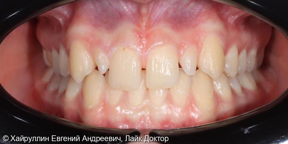 Протезирование зубов верхней челюсти с помощью коронок Emax и виниров Emax - фото №1