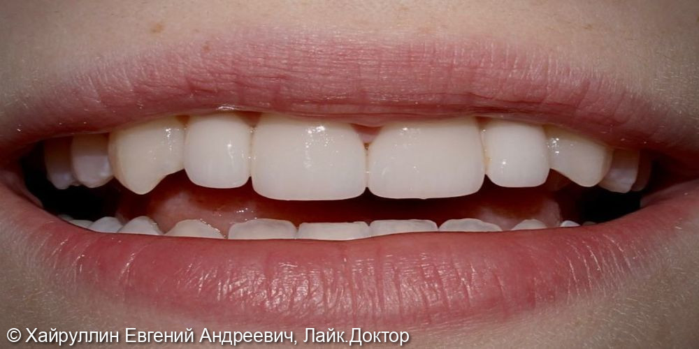 Протезирование зубов верхней челюсти с помощью коронок Emax и виниров Emax - фото №2