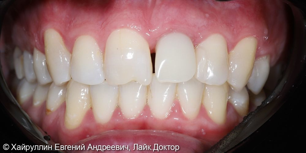 Коронка из диоксида циркония фото 2 · Вологда