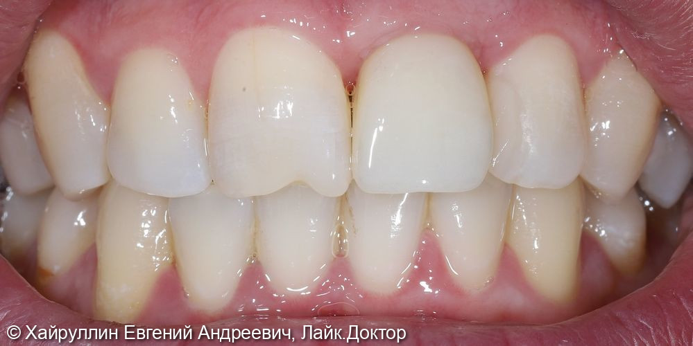 Коронка из диоксида циркония фото 3 · Вологда