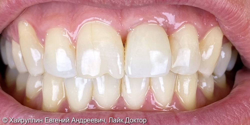 Коронка из диоксида циркония фото 4 · Вологда