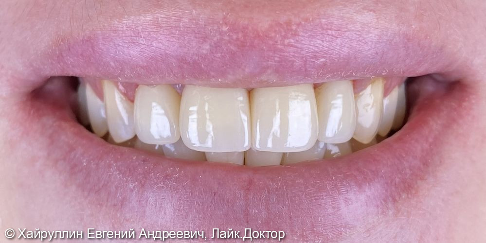 Протезирование фото 7 · Вологда