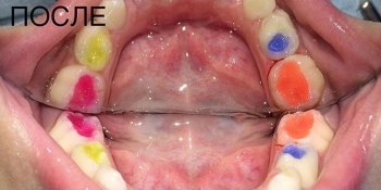 Лечение кариеса молочных зубов цветным композитом - фото №2