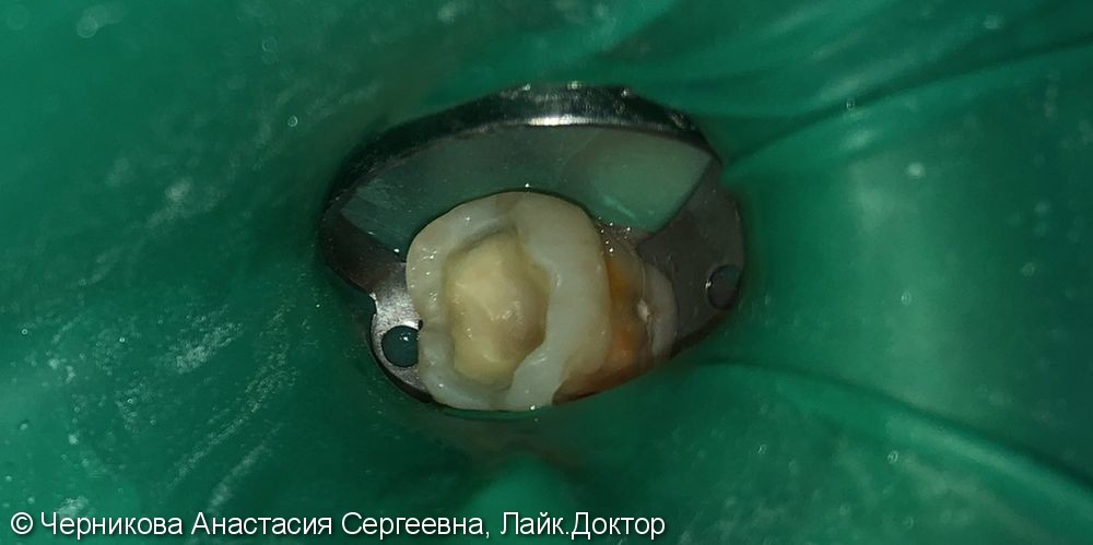 лечение глубокого кариеса 3.6 зуба - фото №1