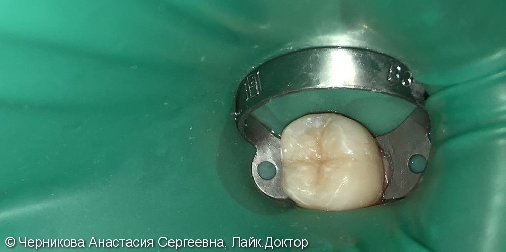 лечение глубокого кариеса 3.6 зуба - фото №2