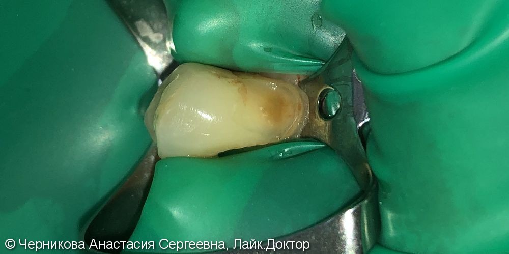 лечение пришеечного кариеса 1.3 зуба - фото №1
