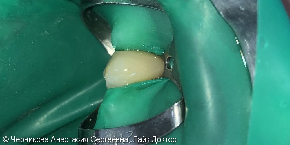 лечение пришеечного кариеса 1.3 зуба - фото №2