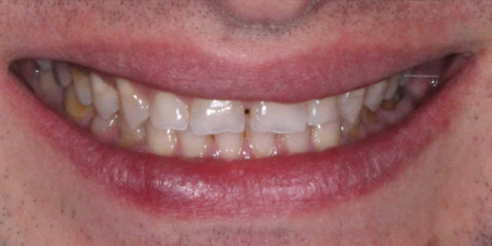 Реставрация стёртых зубов керамическими винирами - фото №1