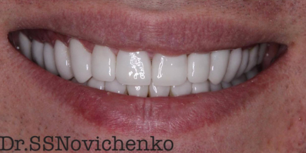 Реставрация стёртых зубов керамическими винирами - фото №2