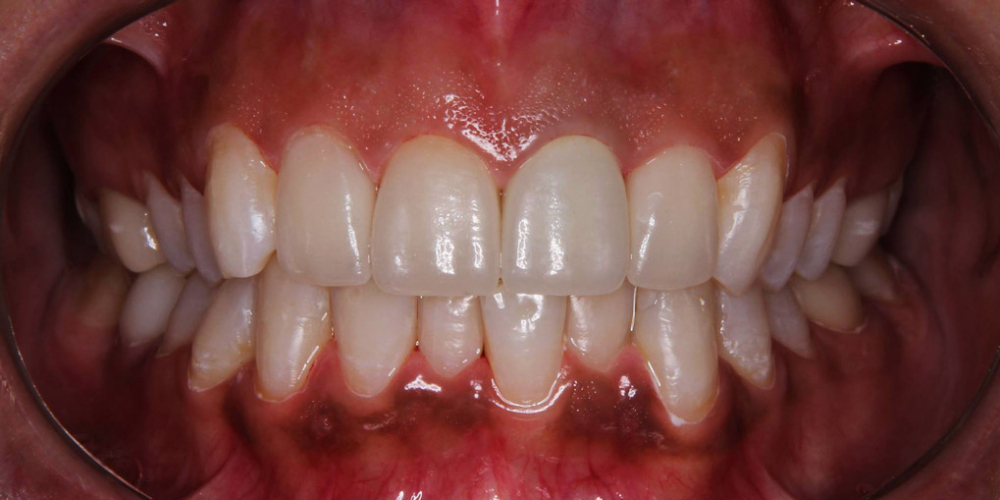 4 керамических винира + отбеливание зубов - фото №3