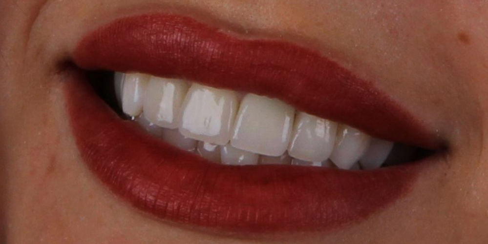 4 керамических винира + отбеливание зубов - фото №2