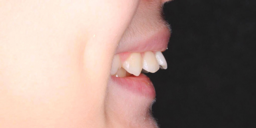 Лечение ортодонтической пластинкой - фото №1