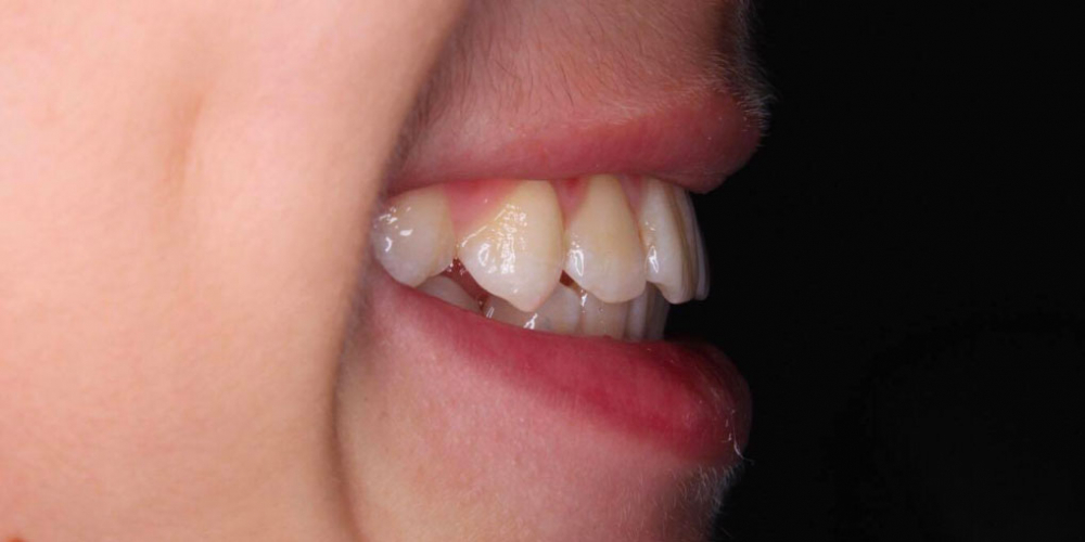 Лечение ортодонтической пластинкой - фото №5