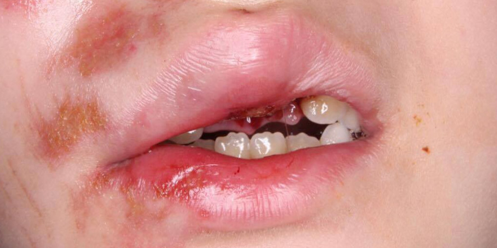 Реплантация передних зубов у ребенка - фото №1