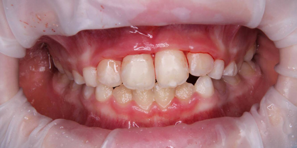 Реплантация передних зубов у ребенка - фото №4