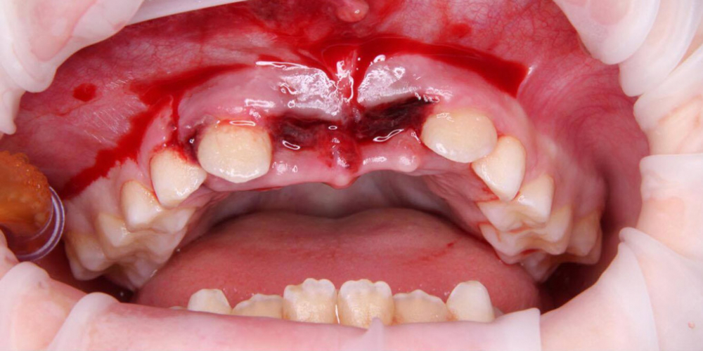 Реплантация передних зубов у ребенка - фото №3
