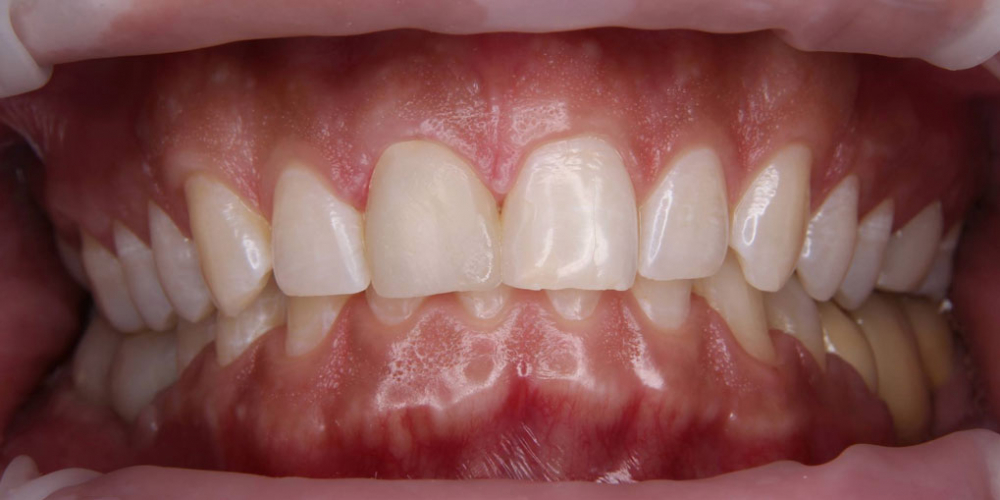 Керамическая коронка на передний зуб - фото №4