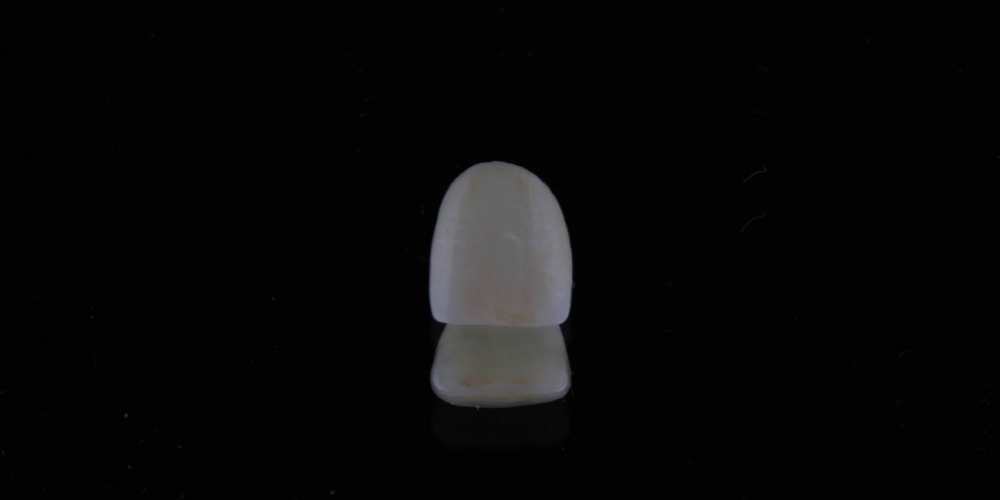Керамическая коронка на передний зуб - фото №3