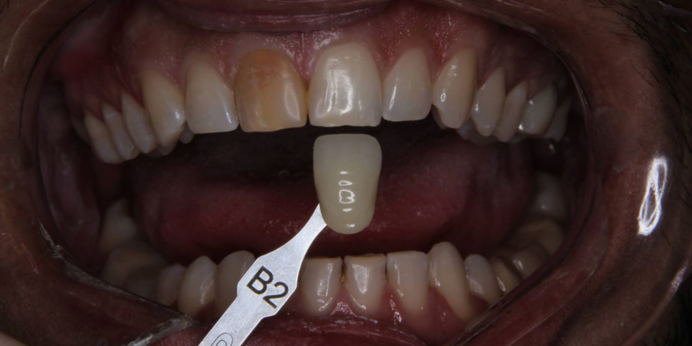 Керамическая коронка на передний зуб - фото №2