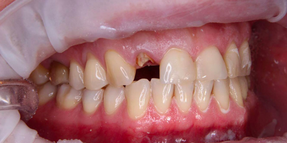 Спасение зуба и восстановление коронкой - фото №1