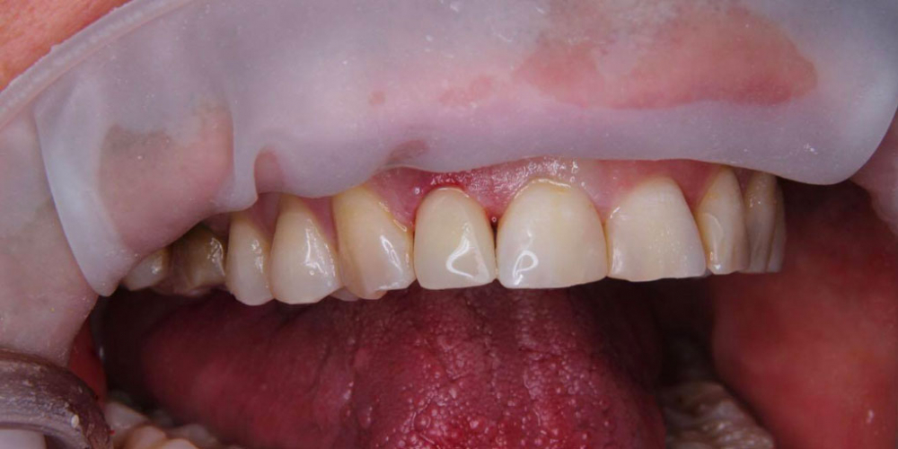 Спасение зуба и восстановление коронкой - фото №9
