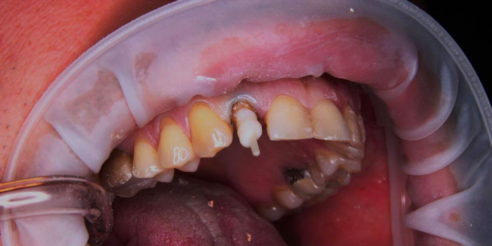 Спасение зуба и восстановление коронкой - фото №4