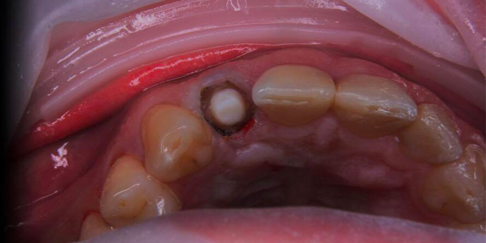 Спасение зуба и восстановление коронкой - фото №5